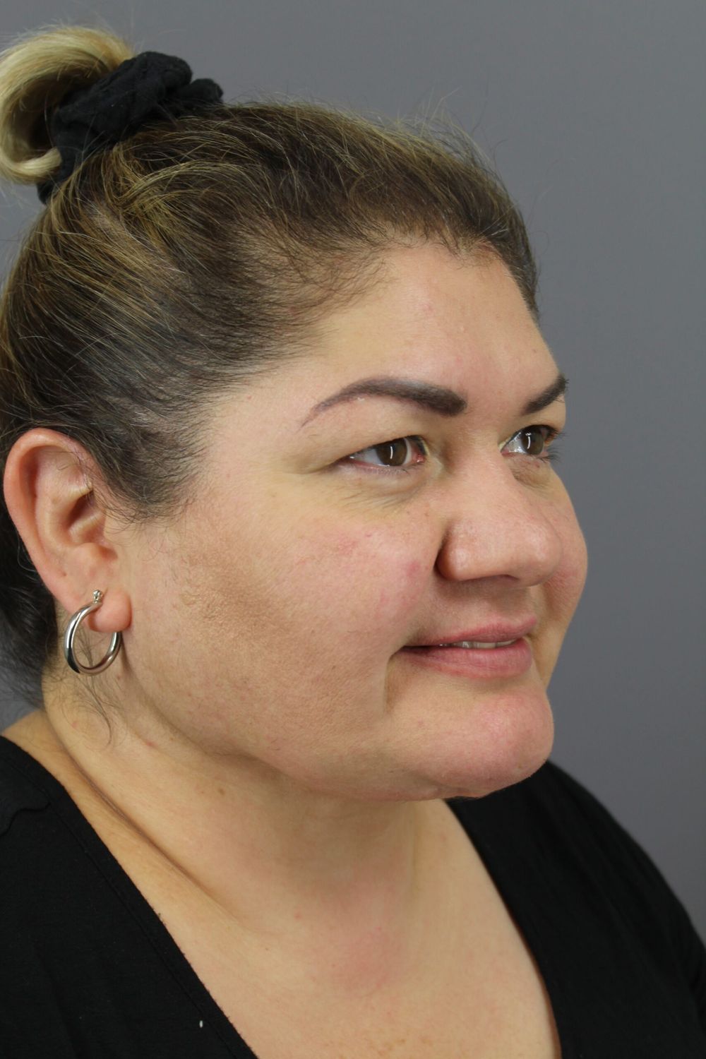 Neck Lift Before & After