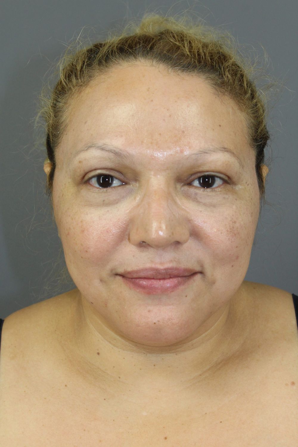 Neck Lift Before & After