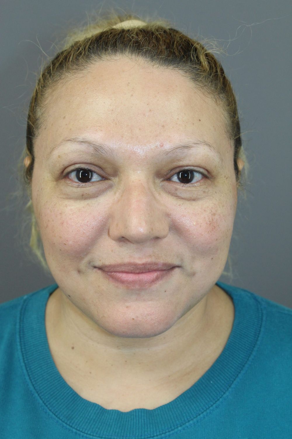 Neck Lift Before & After