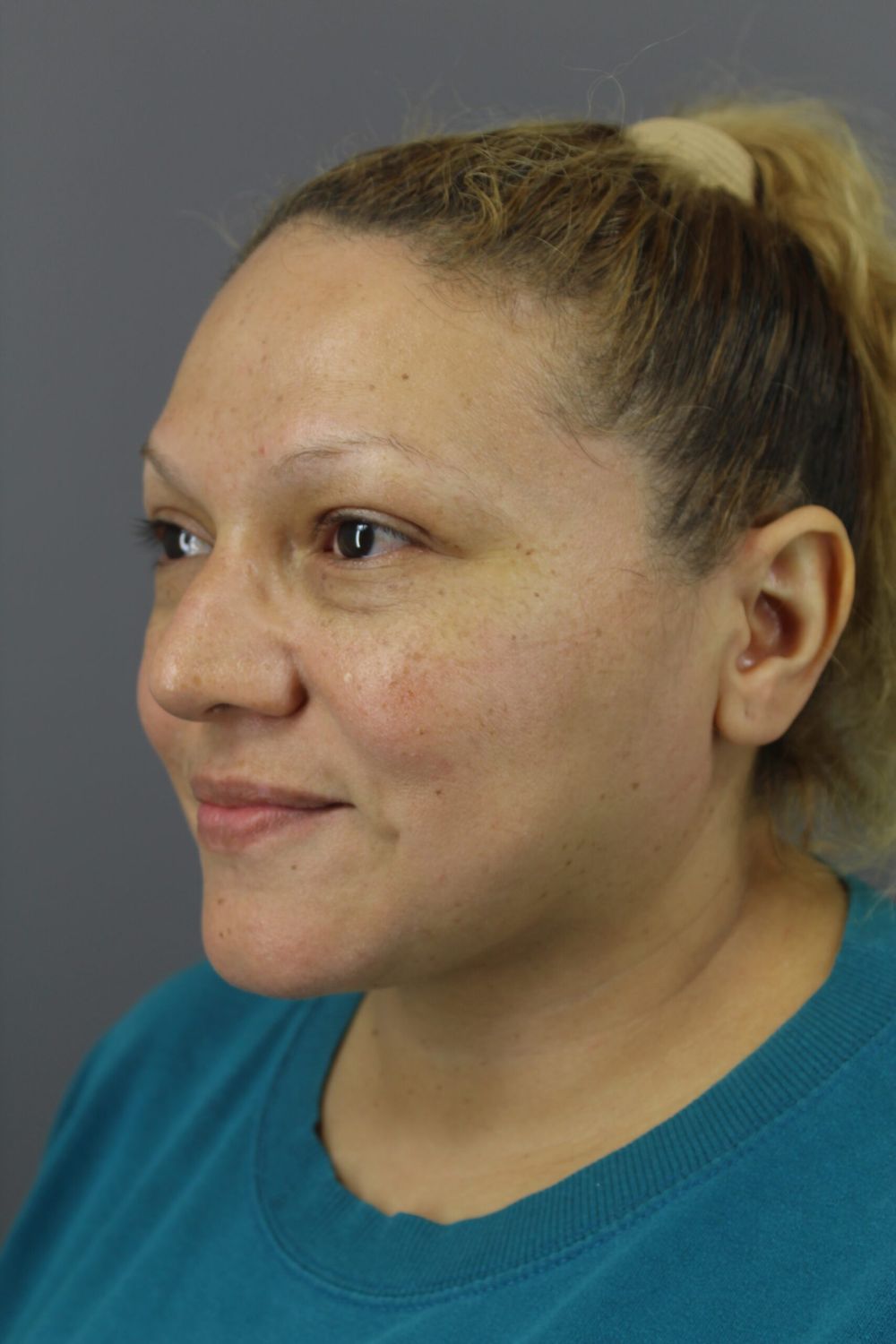 Neck Lift Before & After