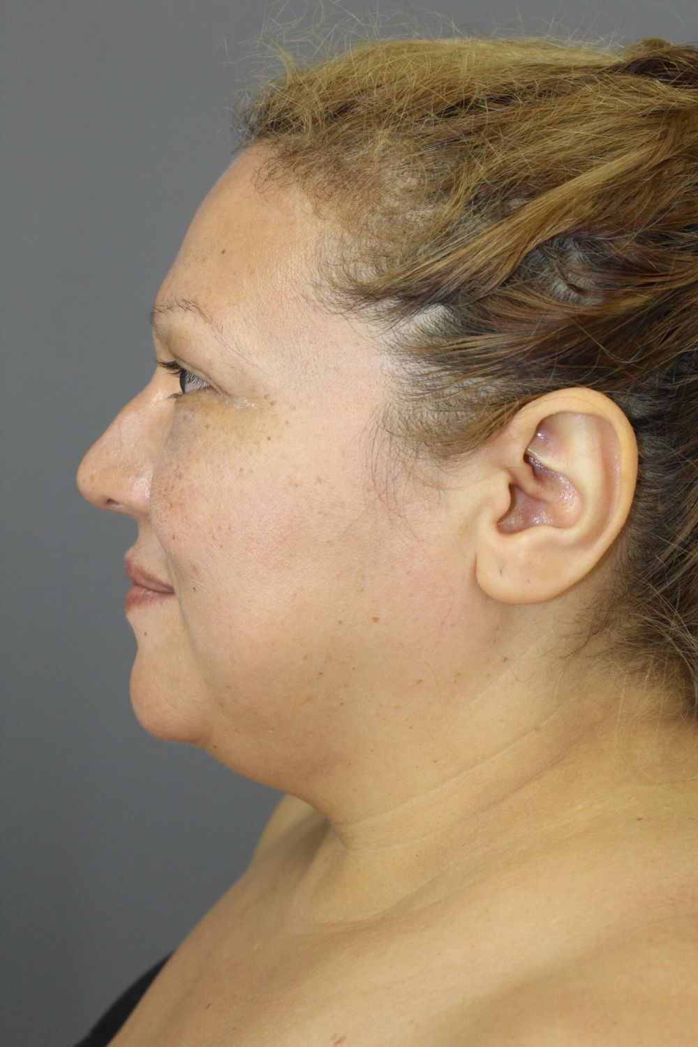 Neck Lift Before & After