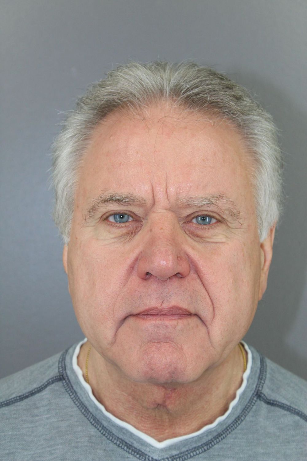 Neck Lift Before & After