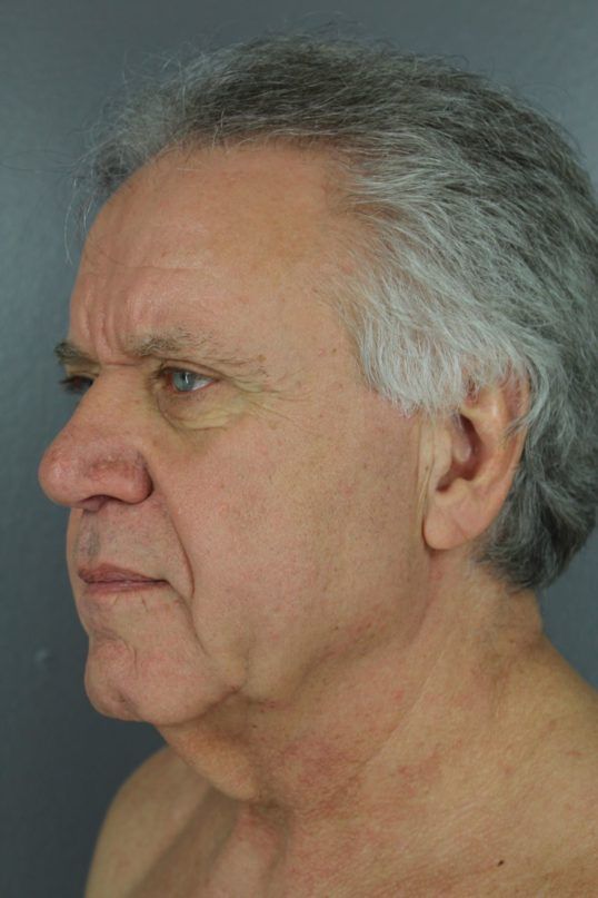 Neck Lift Before & After