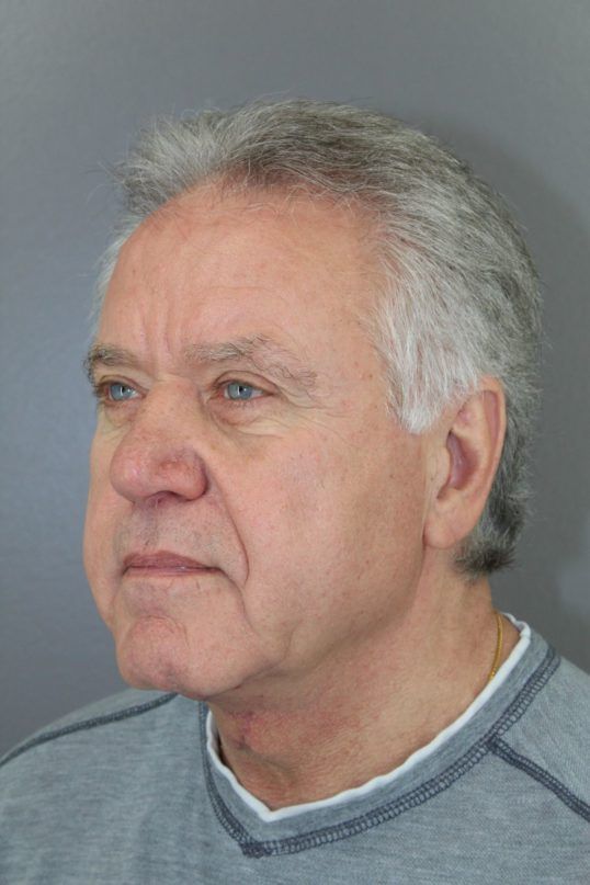 Neck Lift Before & After