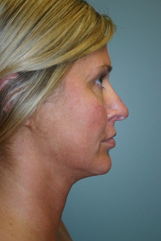 Neck Lift Before & After