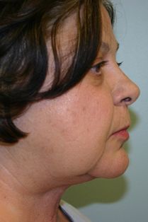 Neck Lift Before & After