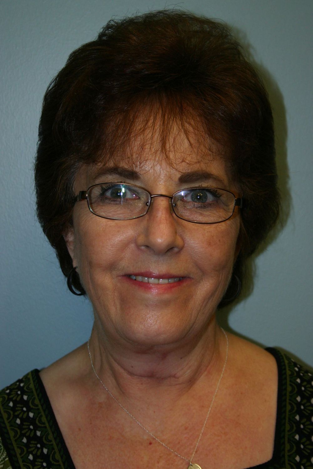 Neck Lift Before & After