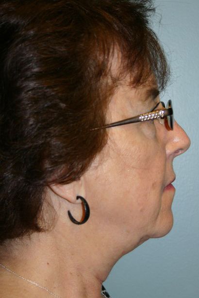 Neck Lift Before & After
