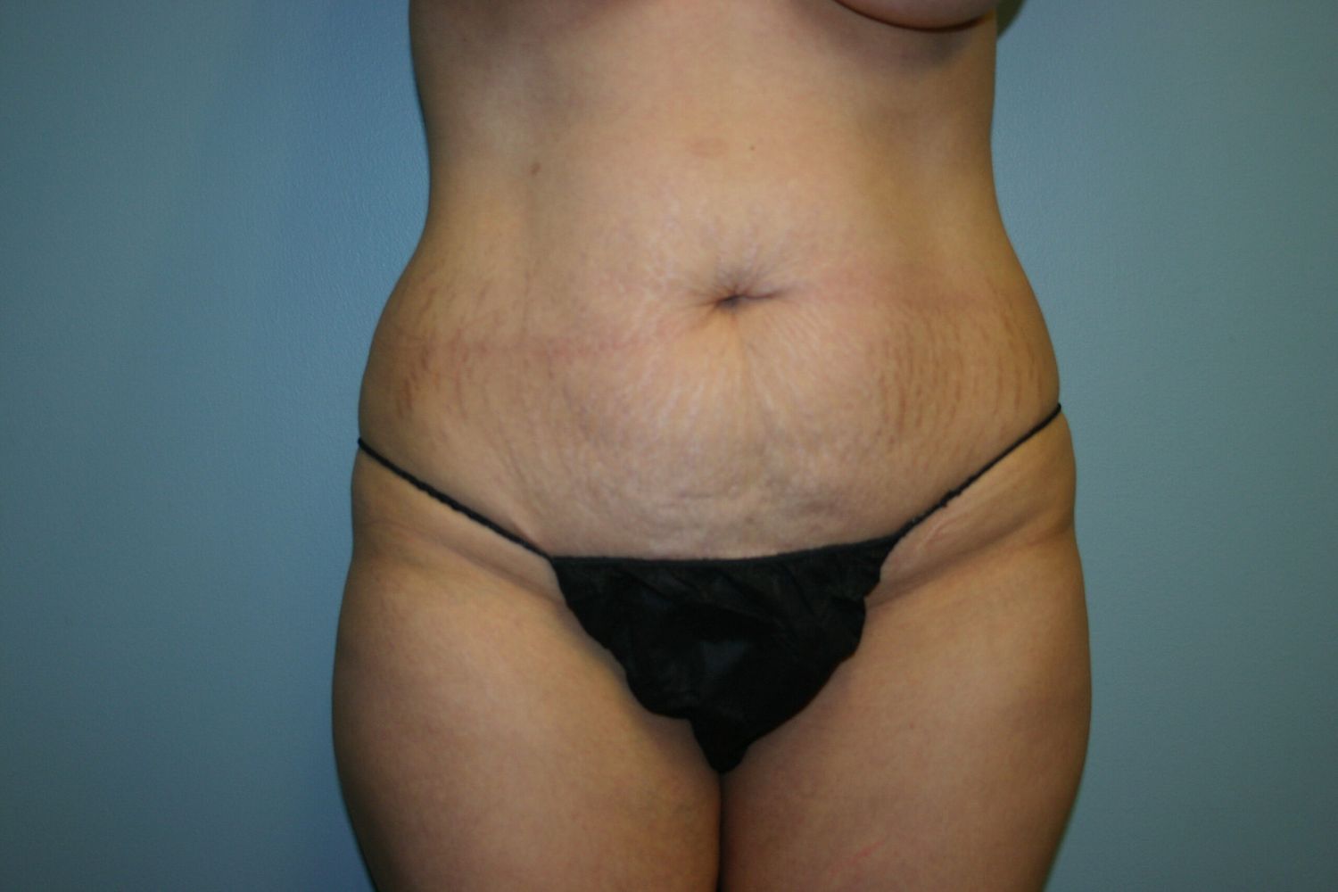 Body Contouring Before & After