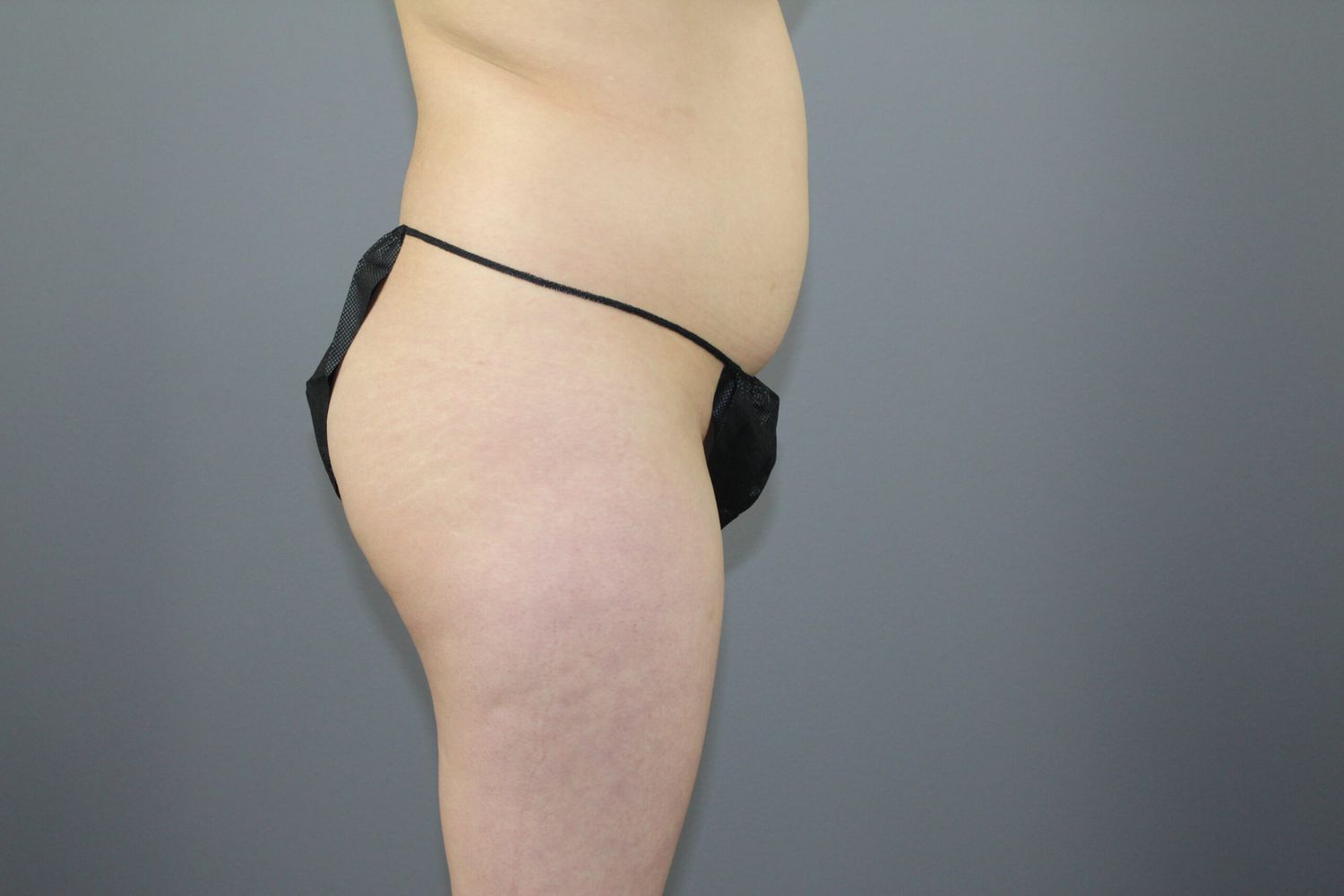 Body Contouring Before & After