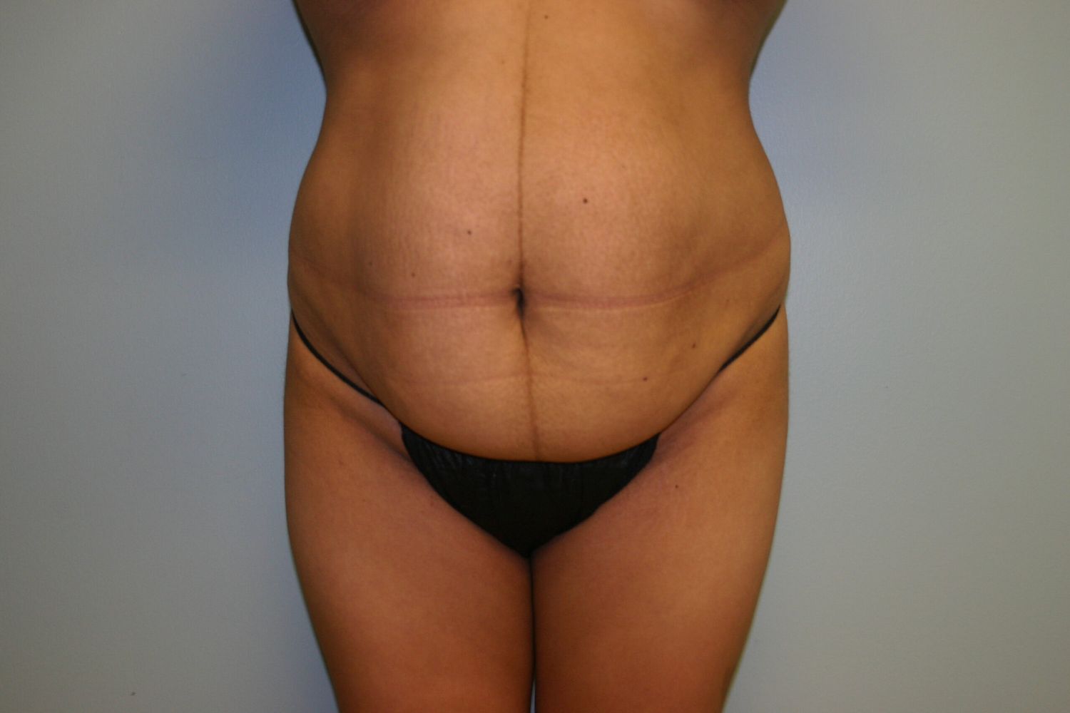 Body Contouring Before & After