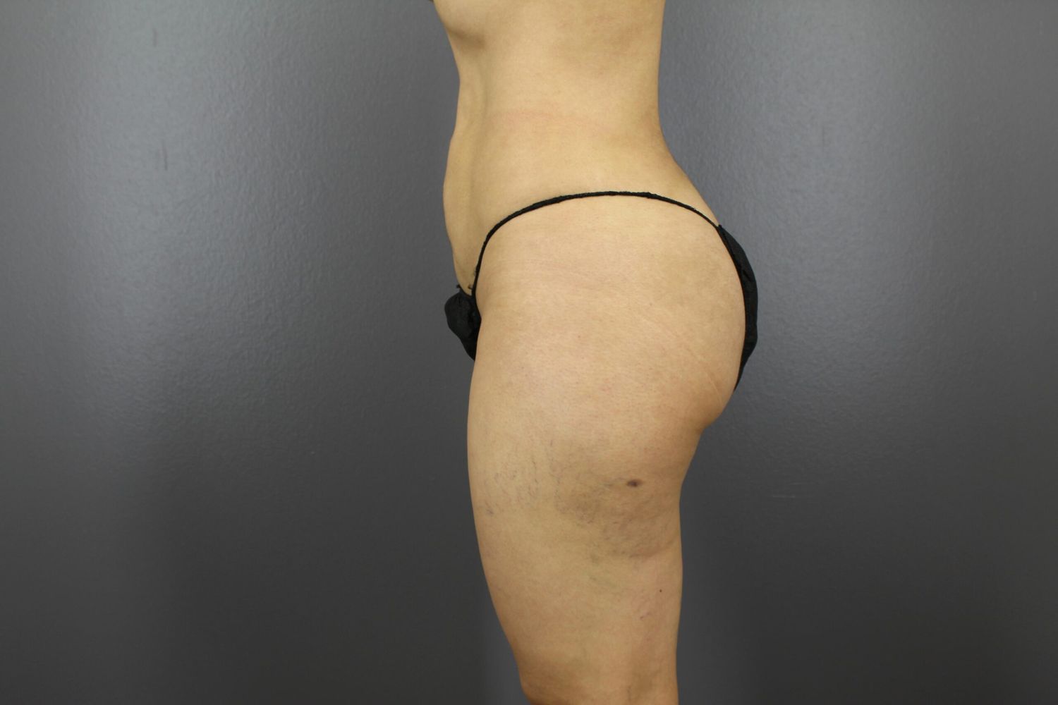 Body Contouring Before & After
