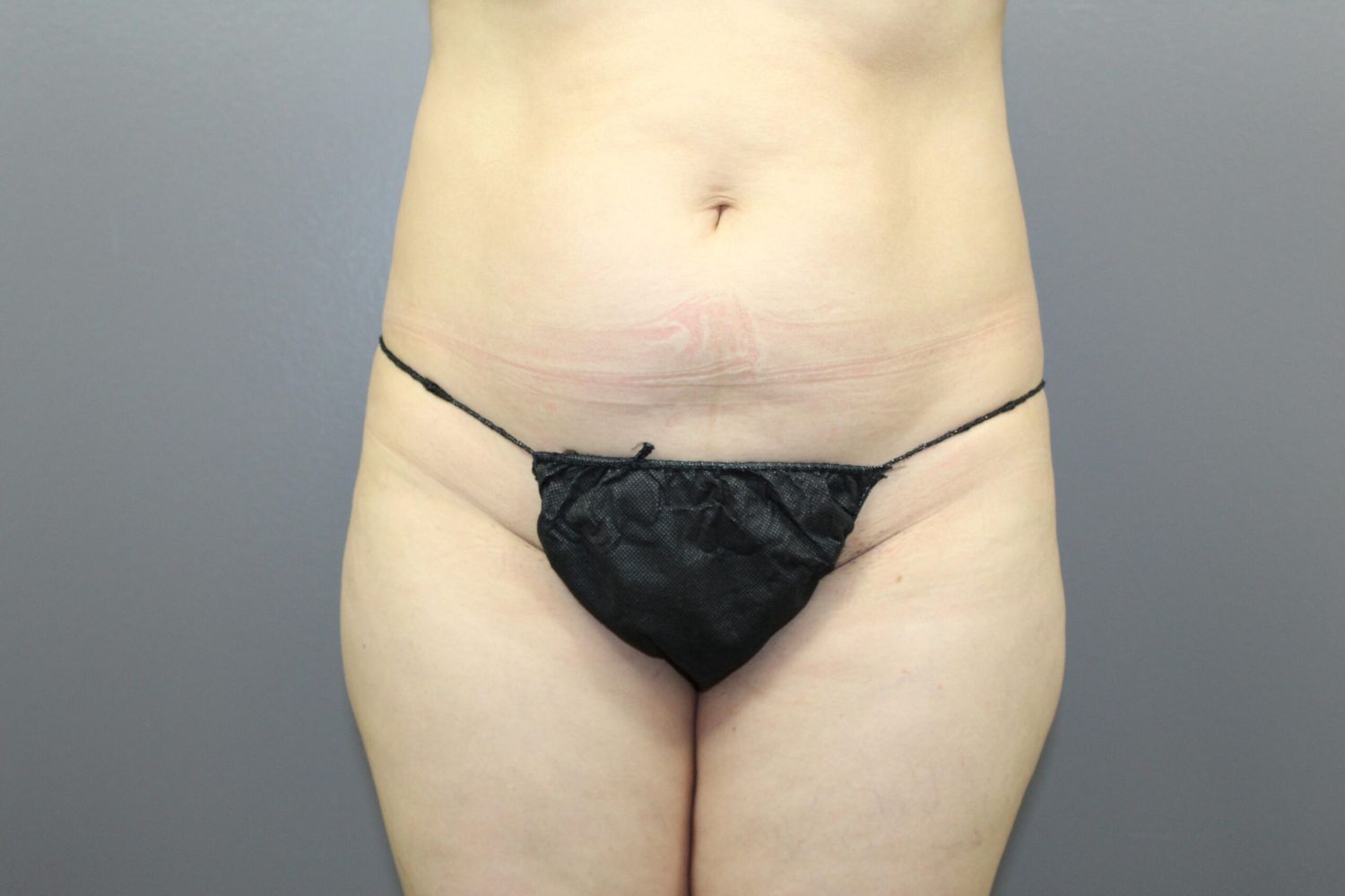 Body Contouring Before & After