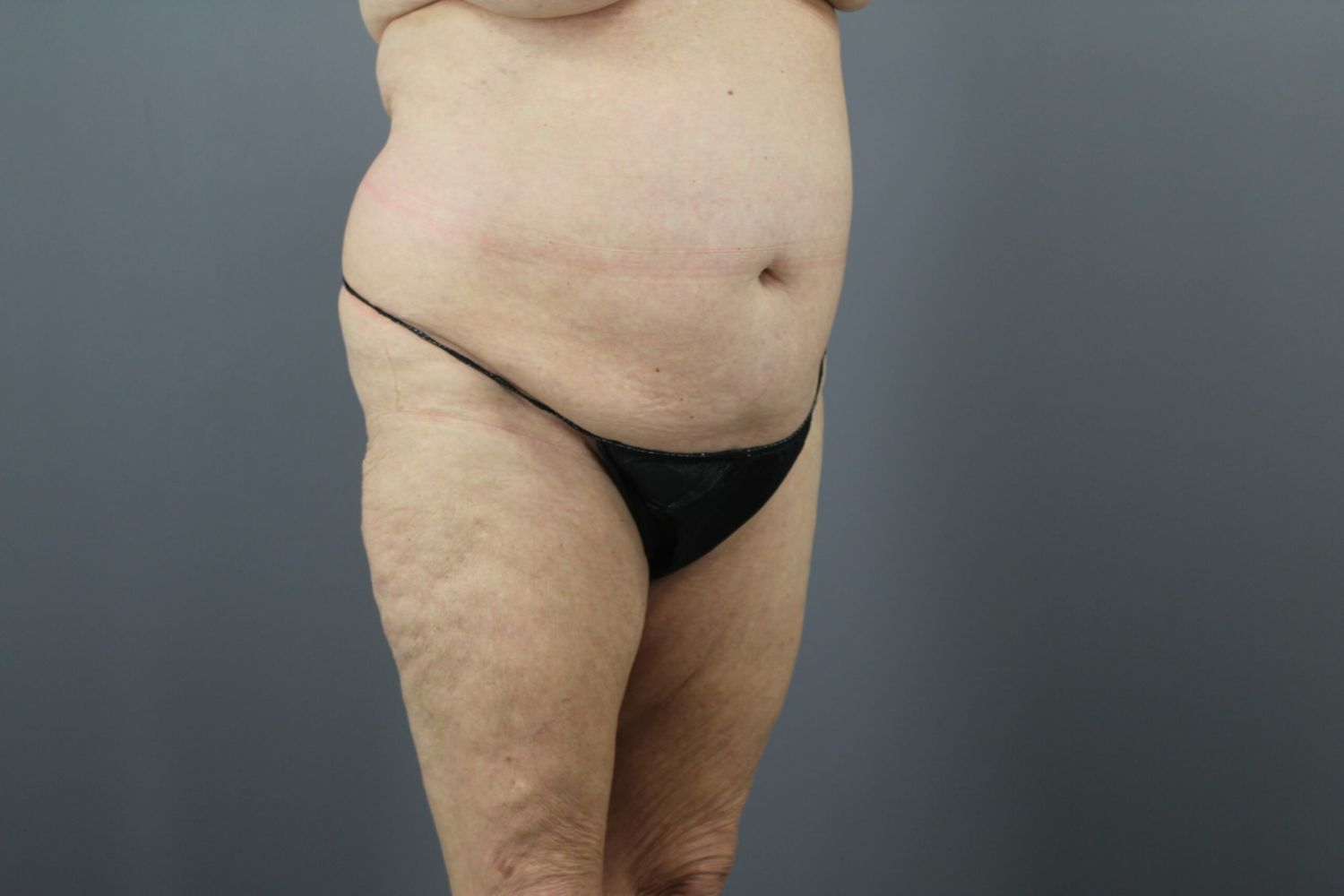 Body Contouring Before & After