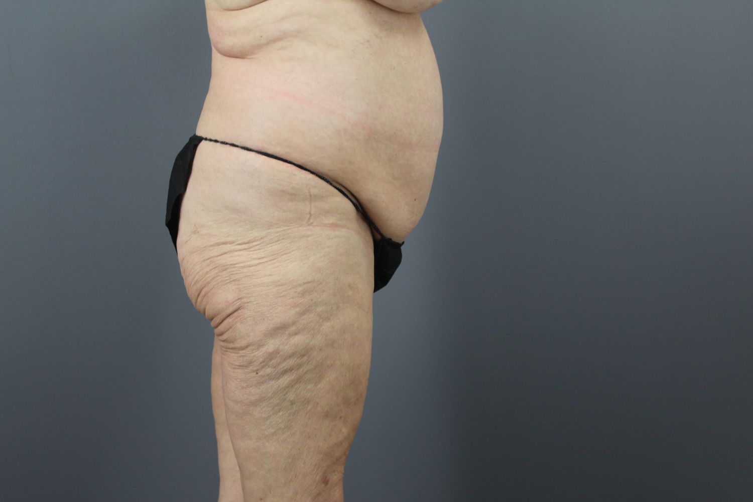 Body Contouring Before & After