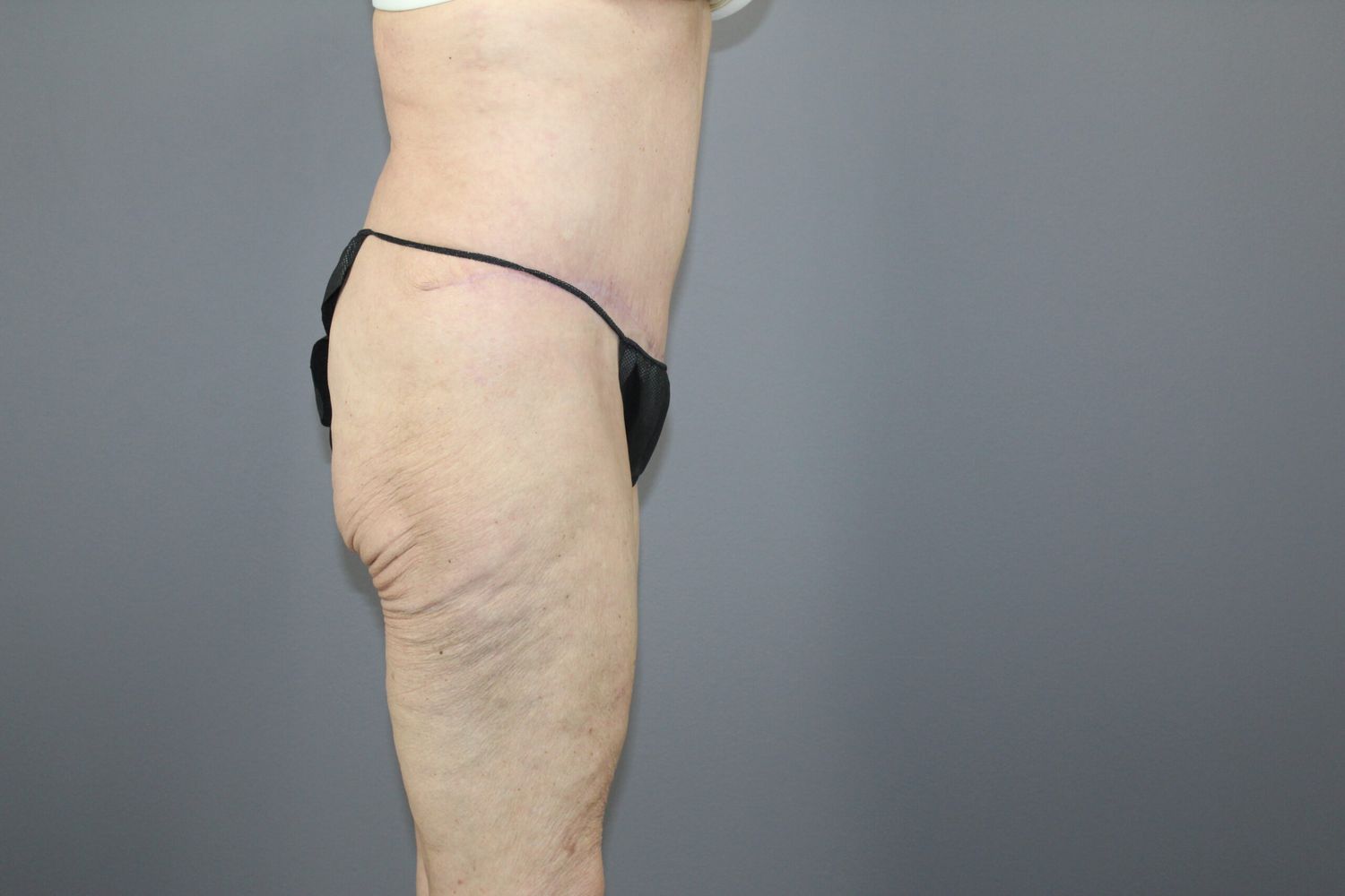 Body Contouring Before & After