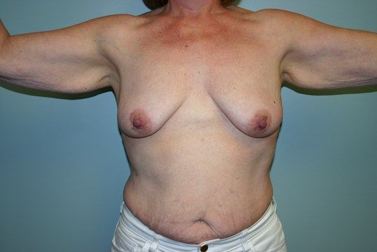 Body Contouring Before & After