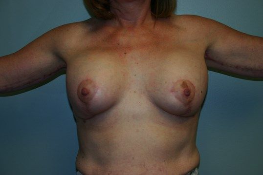 Body Contouring Before & After