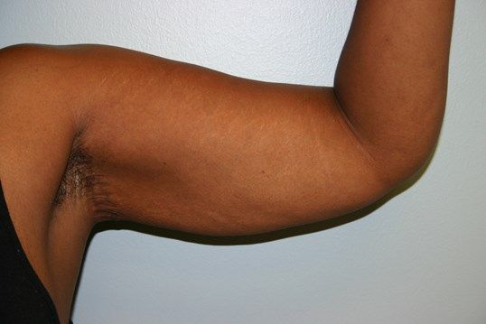 Body Contouring Before & After