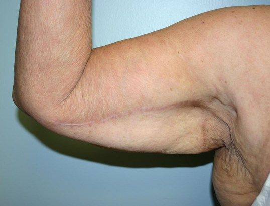 Body Contouring Before & After