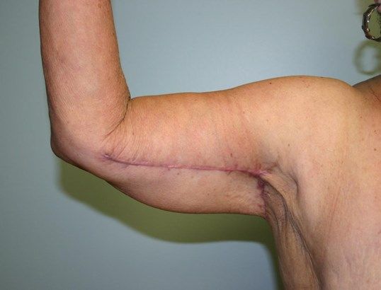 Body Contouring Before & After