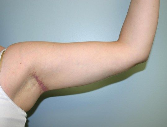 Body Contouring Before & After