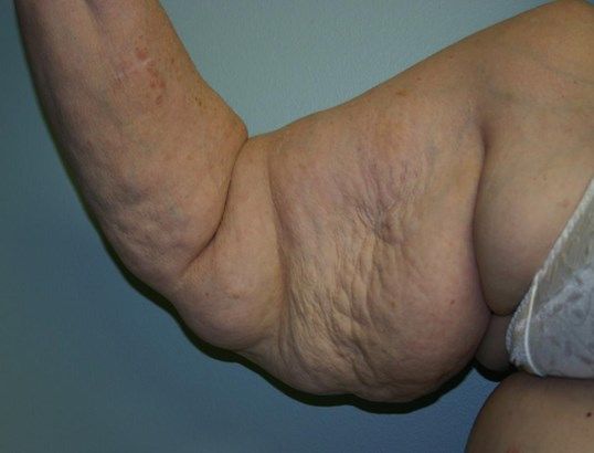 Body Contouring Before & After