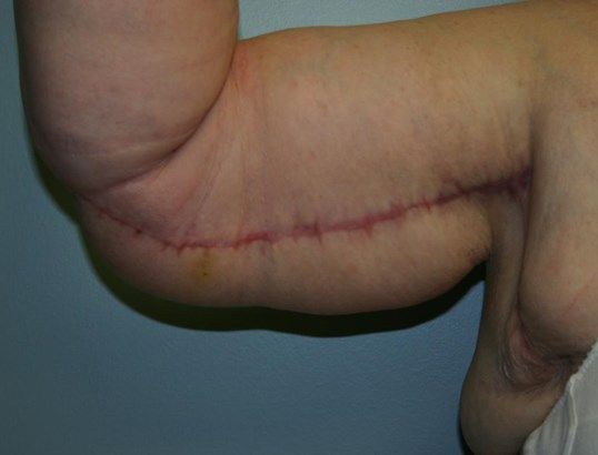 Body Contouring Before & After