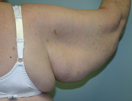 Body Contouring Before & After