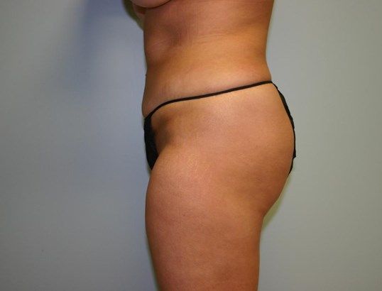 Body Contouring Before & After