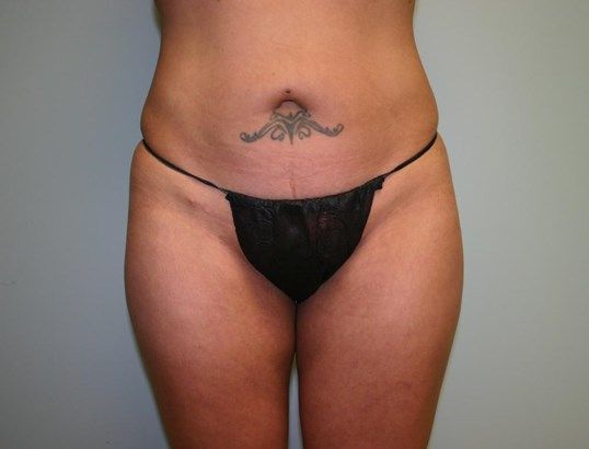 Body Contouring Before & After