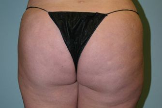 Body Contouring Before & After