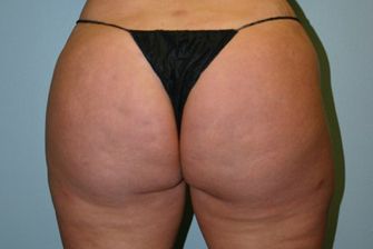 Body Contouring Before & After