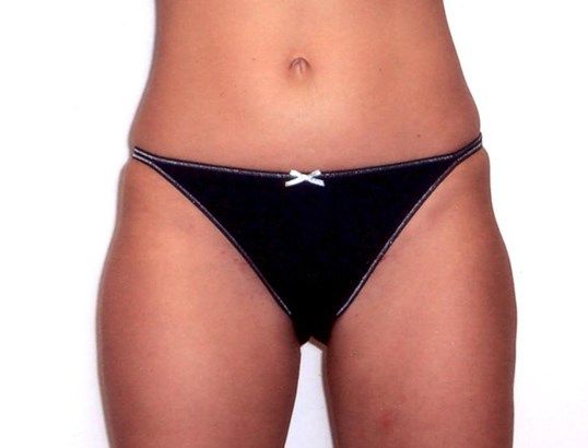 Body Contouring Before & After