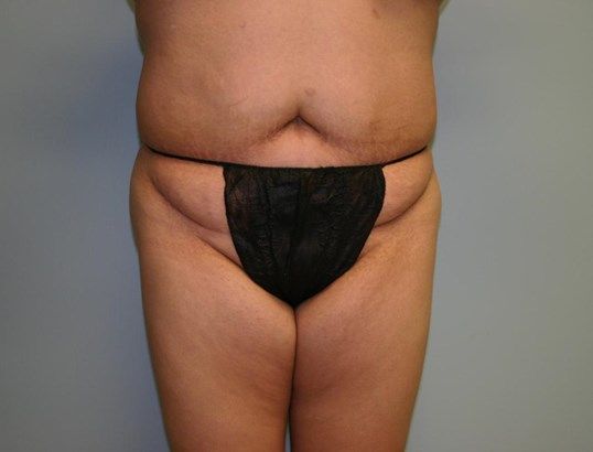 Body Contouring Before & After