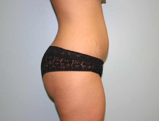 Body Contouring Before & After