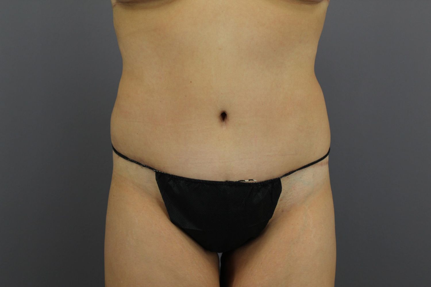 Body Contouring Before & After
