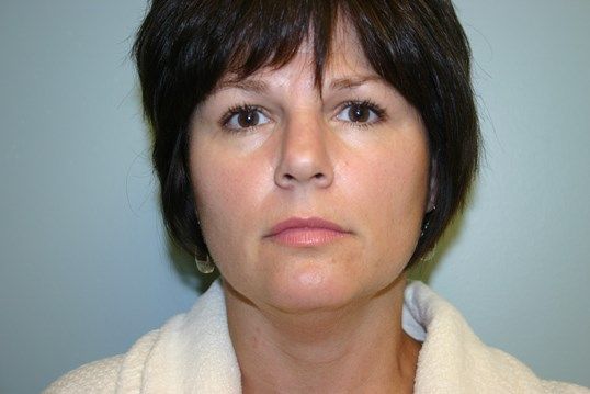 Body Contouring Before & After