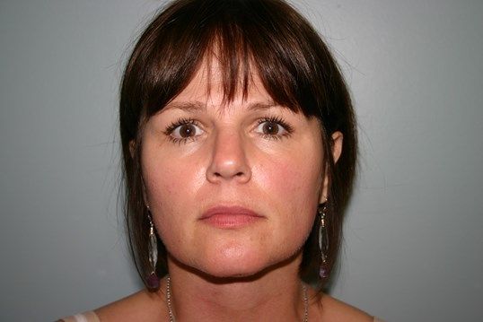 Body Contouring Before & After