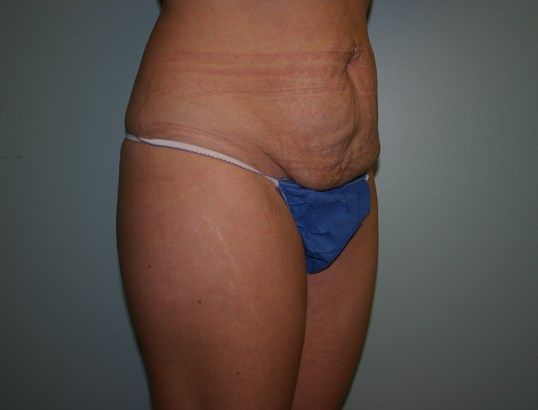 Body Contouring Before & After