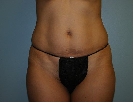 Body Contouring Before & After