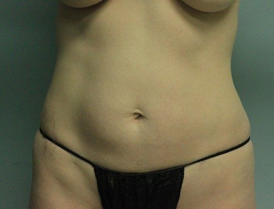 Body Contouring Before & After