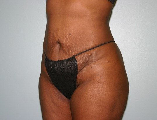 Body Contouring Before & After