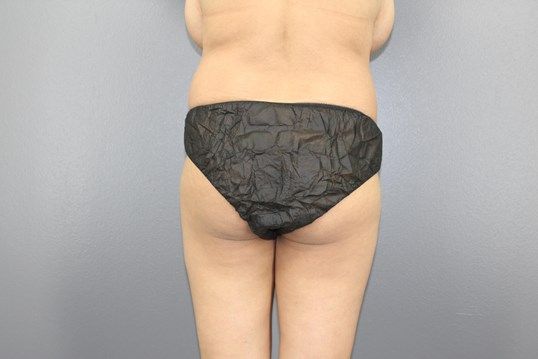 Body Contouring Before & After