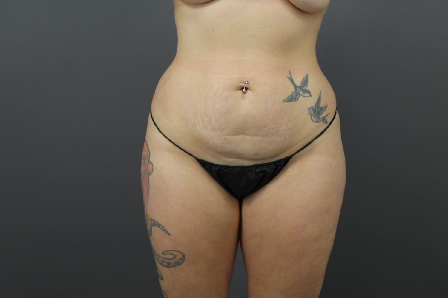 Body Contouring Before & After