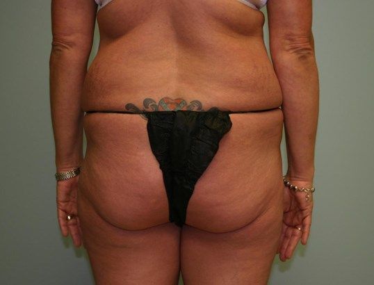 Body Contouring Before & After