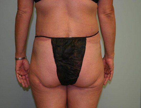 Body Contouring Before & After