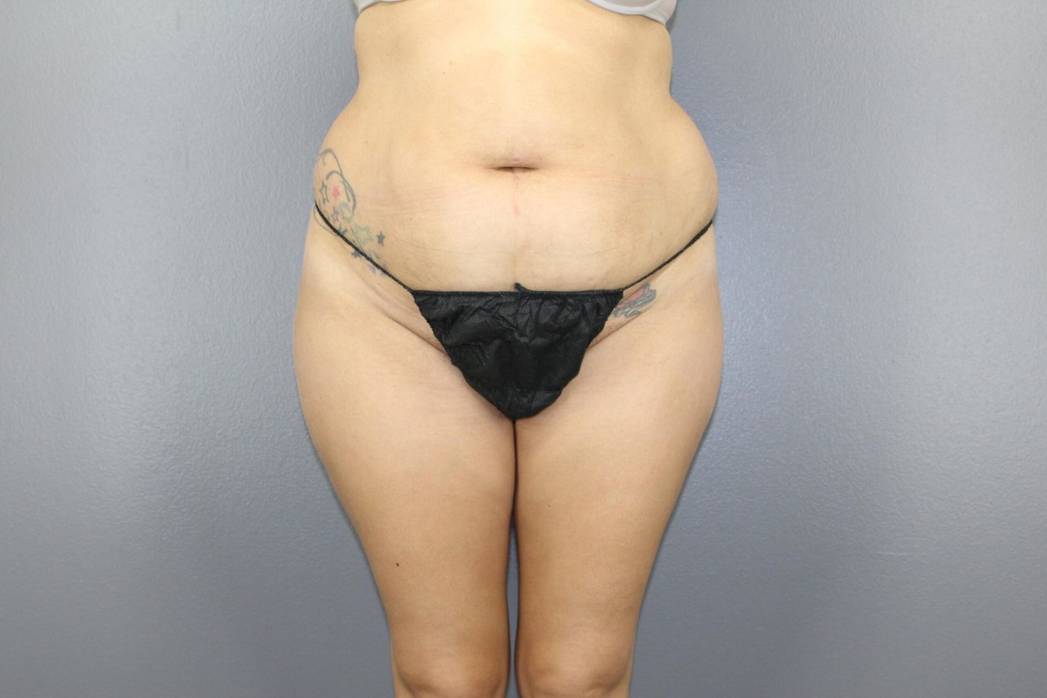 Body Contouring Before & After