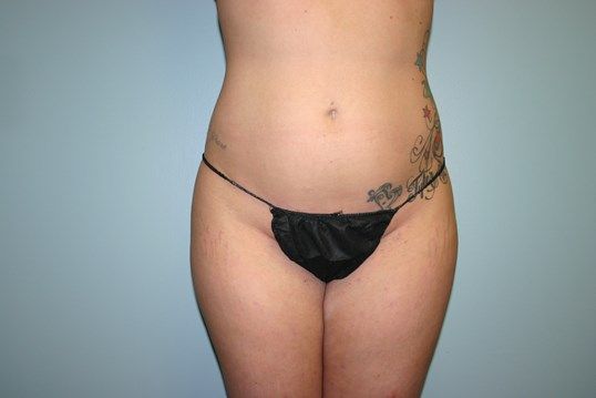 Body Contouring Before & After