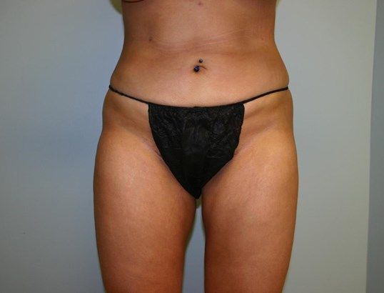 Body Contouring Before & After